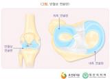 갑자기 무릎이 아파요 - 인대 손상 증상과 원인