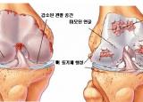 무릎이 아파요. 무릎 인대 파열 치료-침,도수치료,프롤로
