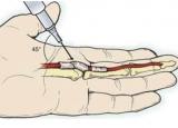 방아쇠수지 주사, 보조기 - 손가락통증 치료방법 