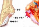 발목인대수술없이 비수술치료로!-체외충격파,침,도수치료