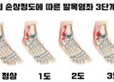 갑작스런 발목통증 - 발목인대손상 원인&증상