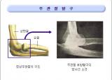 팔꿈치 통증 원인 - 엘보, 관절염, 강직, 터널증후군