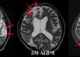 뇌경색 치료방법 - 약물, 보존요법, 혈관재개통